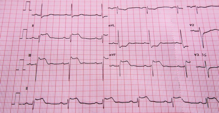 EKG - STEMI - ST tõusu ja südamelihase infarkti tunnused