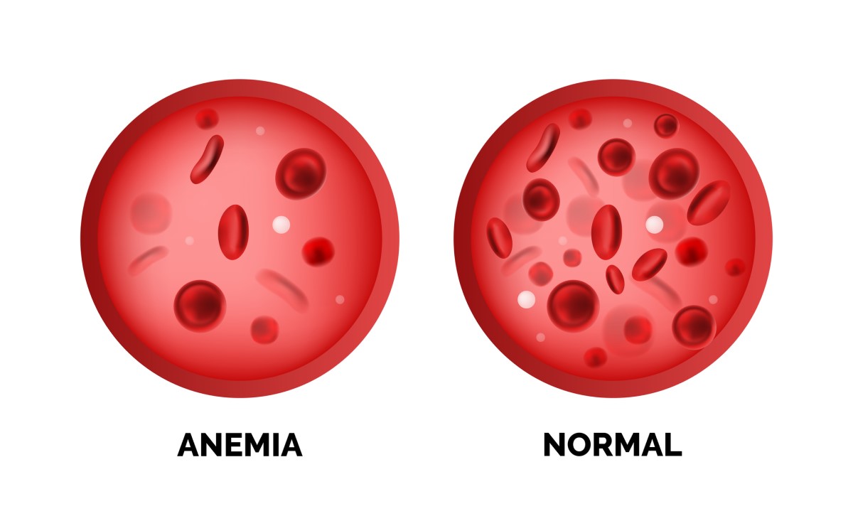 Aneemia ja normaalne vere punaliblede tase