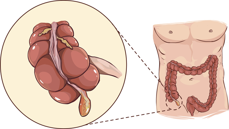 Lisa - anatoomiline kujutis jämesoole alguses