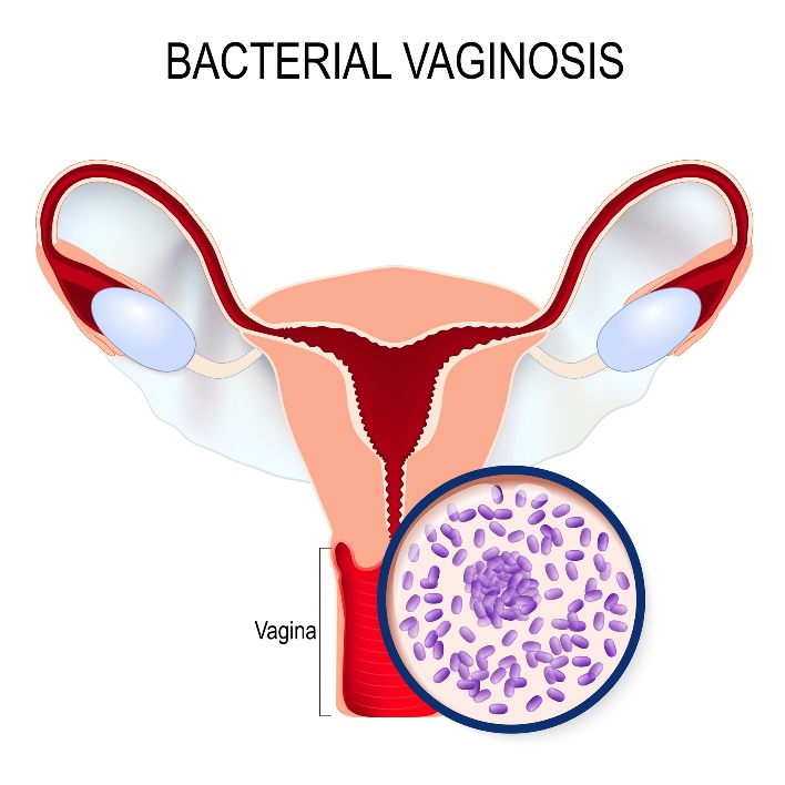 Bakteriaalne vaginoos ja Gardnerella vaginalis'e ülekasvamine