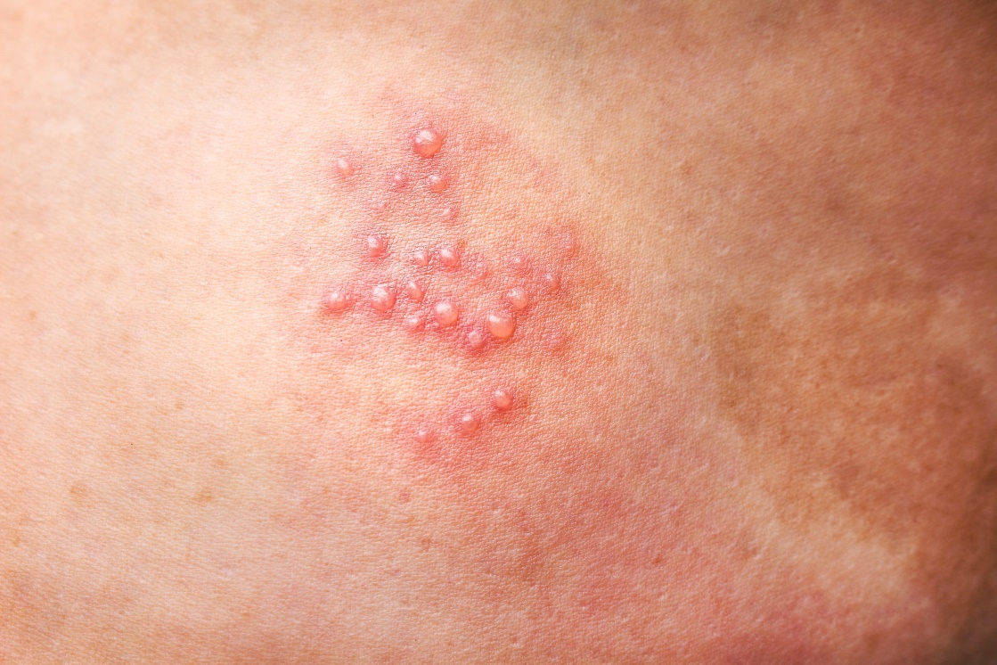 Genitaalherpes