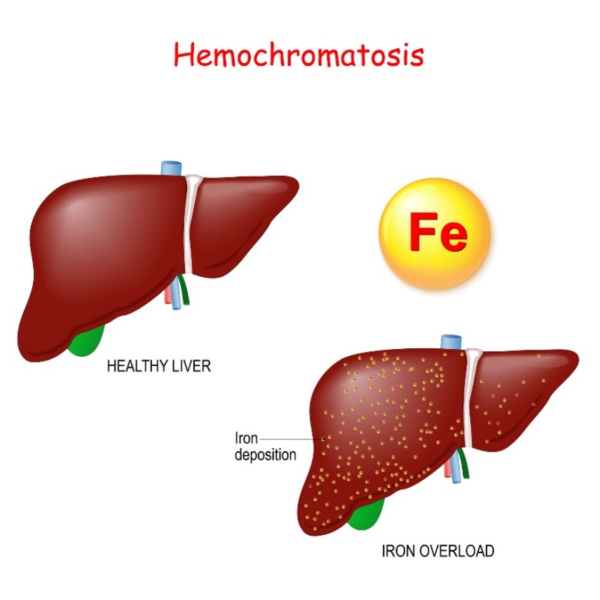 Hemokromatoos: maksa füsioloogia ja patoloogia koos ülemäärase raua (Fe) ladestumisega