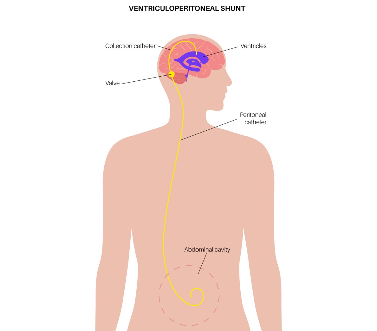 Illustratsioon ventrikulo-abdominaalsest šuntist, mis juhib liigse vedeliku ajust kõhuõõnde.