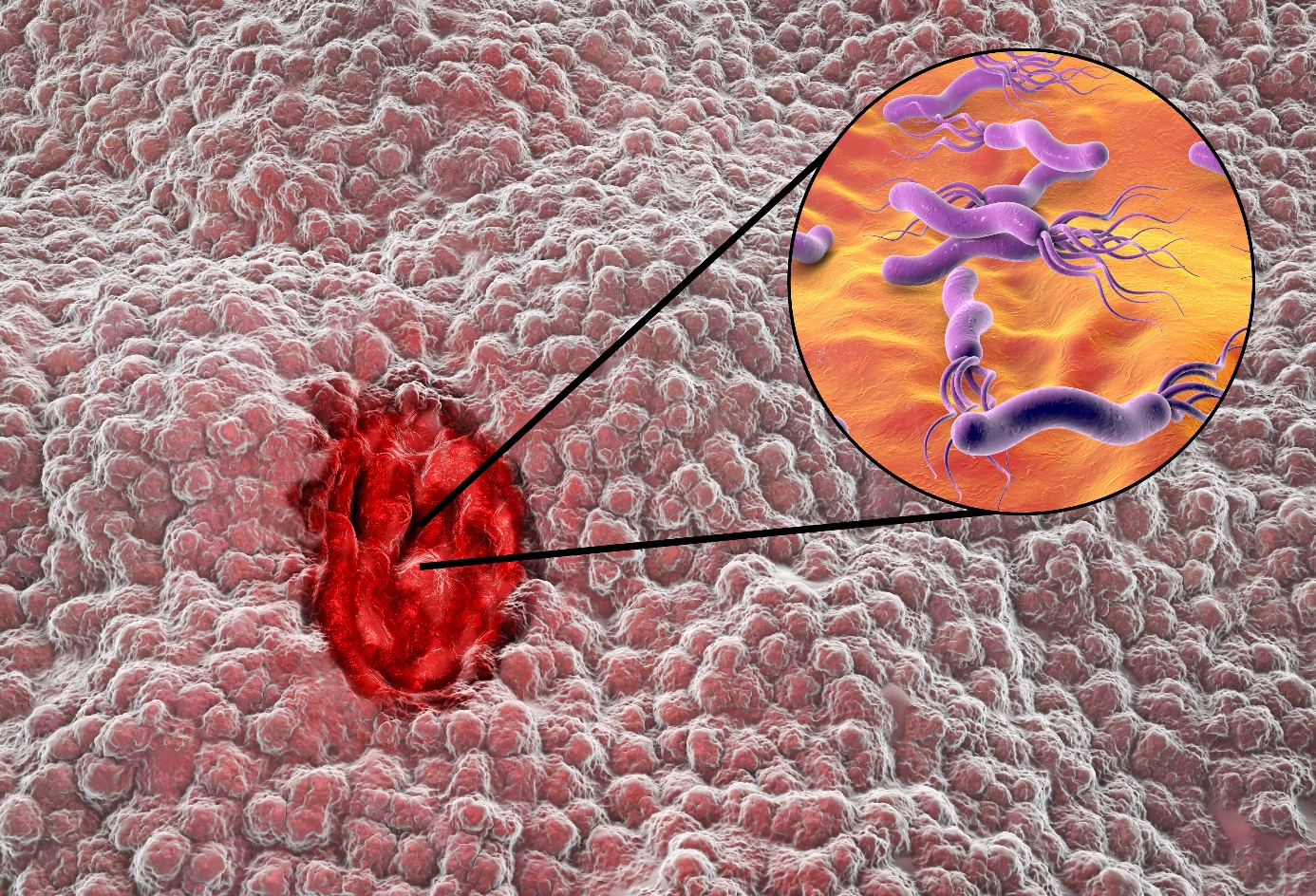 Helicobacter pylori infektsioon