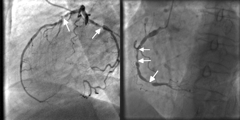 Koronarograafia, angiograafia, koronaararterite ummistus