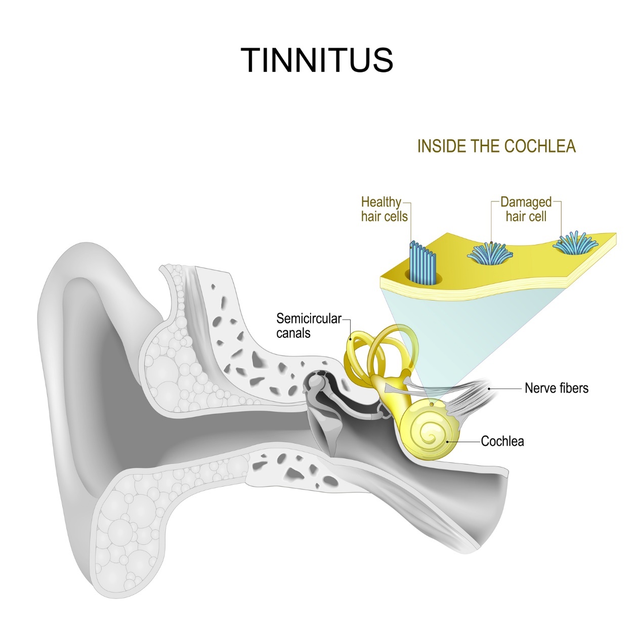 Sisekõrva ja tinnitus - vilistamine ja sumin kõrvus