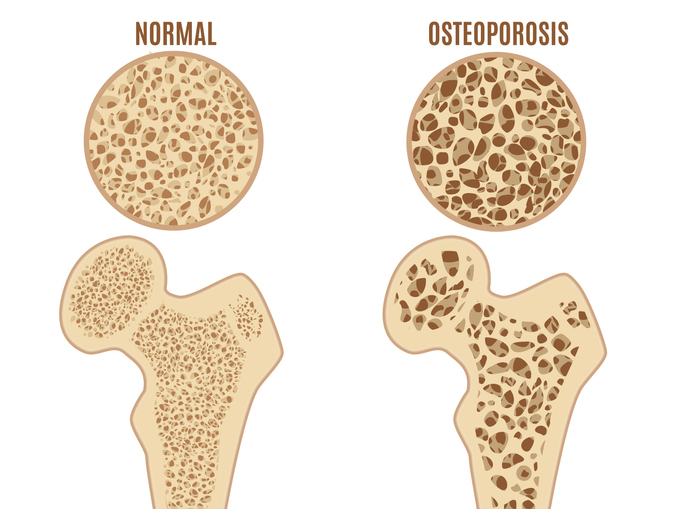 Reieluu osteoporoos