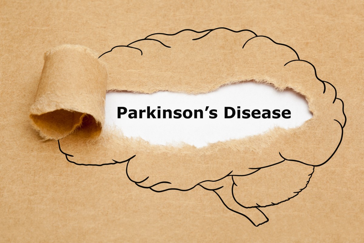 Morbus parkinson = Parkinsoni tõbi = Parkinsoni tõbi - Parkinsoni tõvega aju animatsioon keskeltläbi