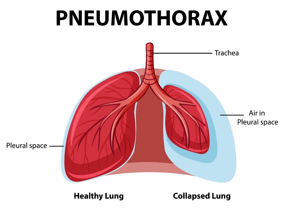 Pneumotooraks: terved ja kokkuvarisevad kopsud