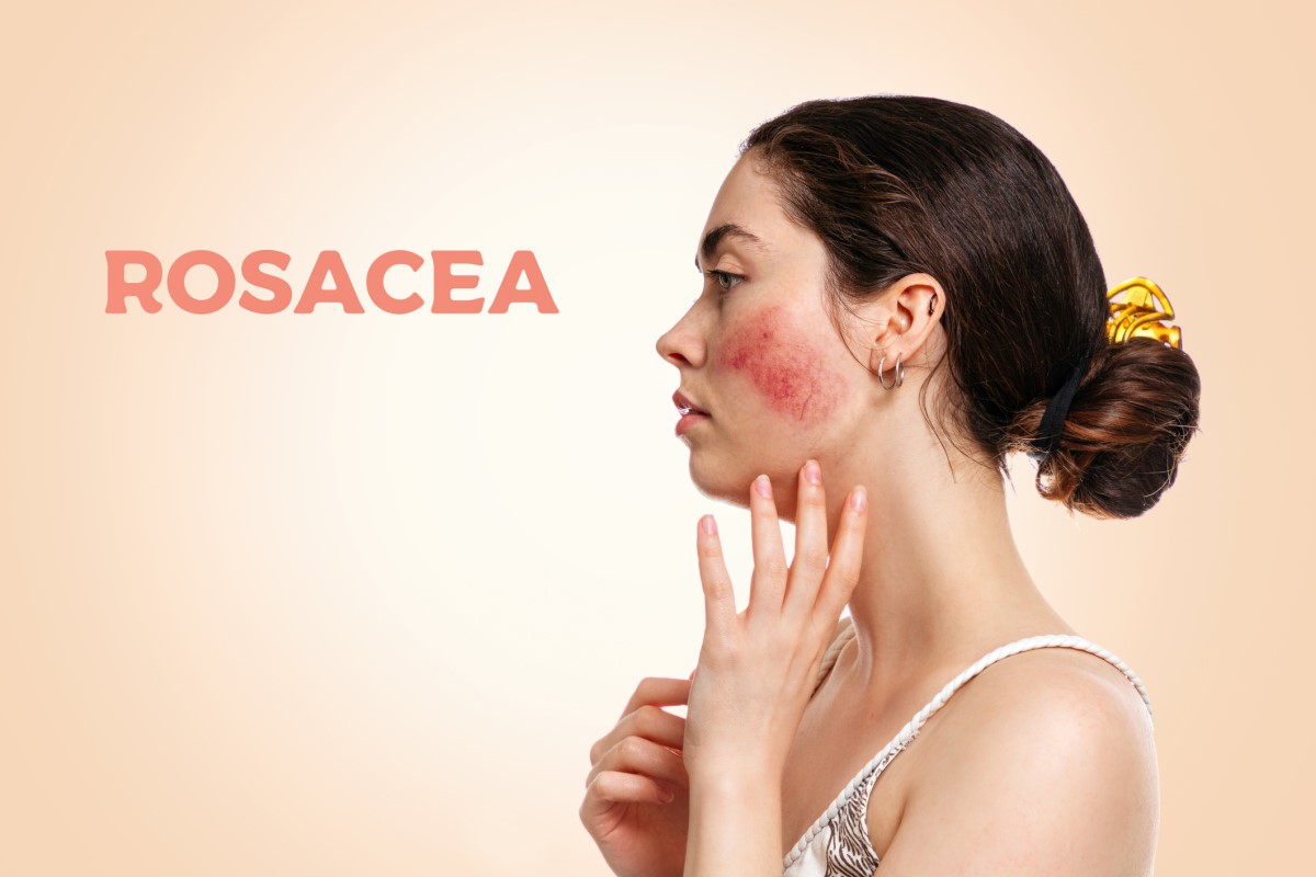 Naine küljelt, nägu rosacea - rosacea