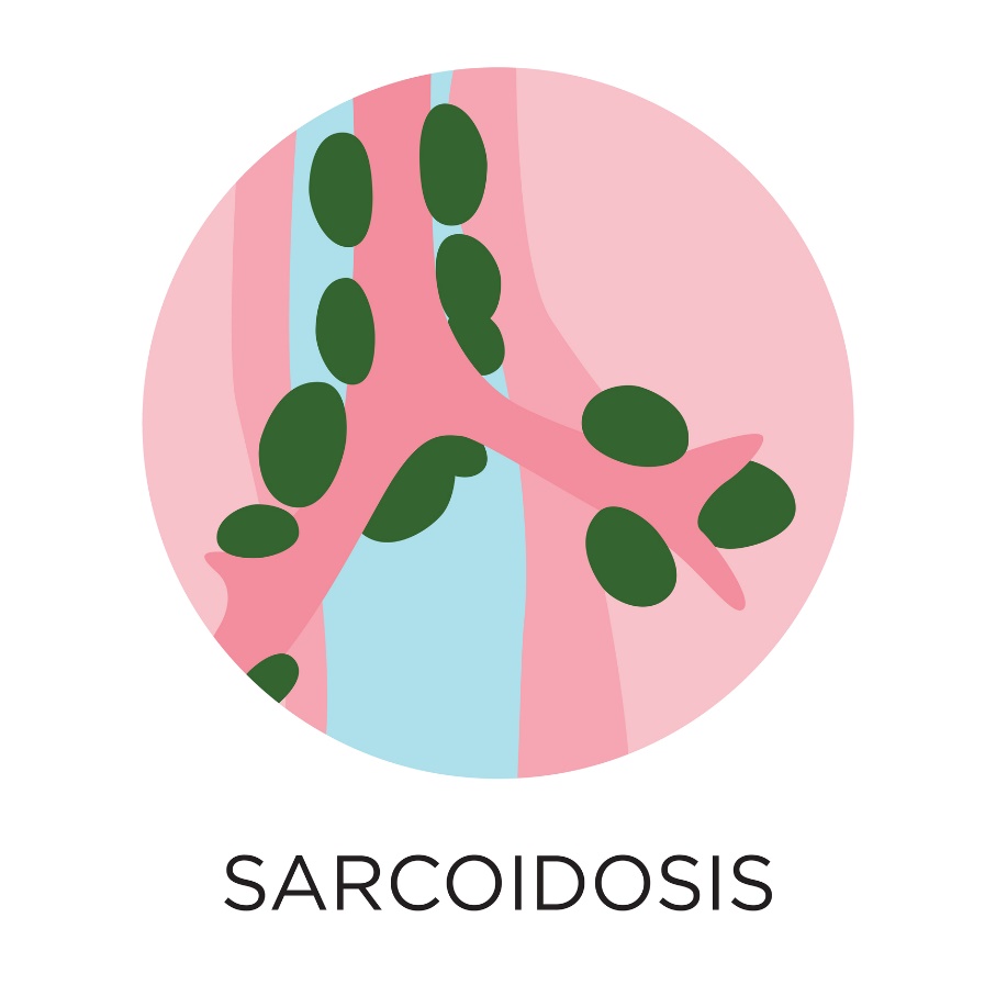 Sarkoidoos - granuloomide moodustumine