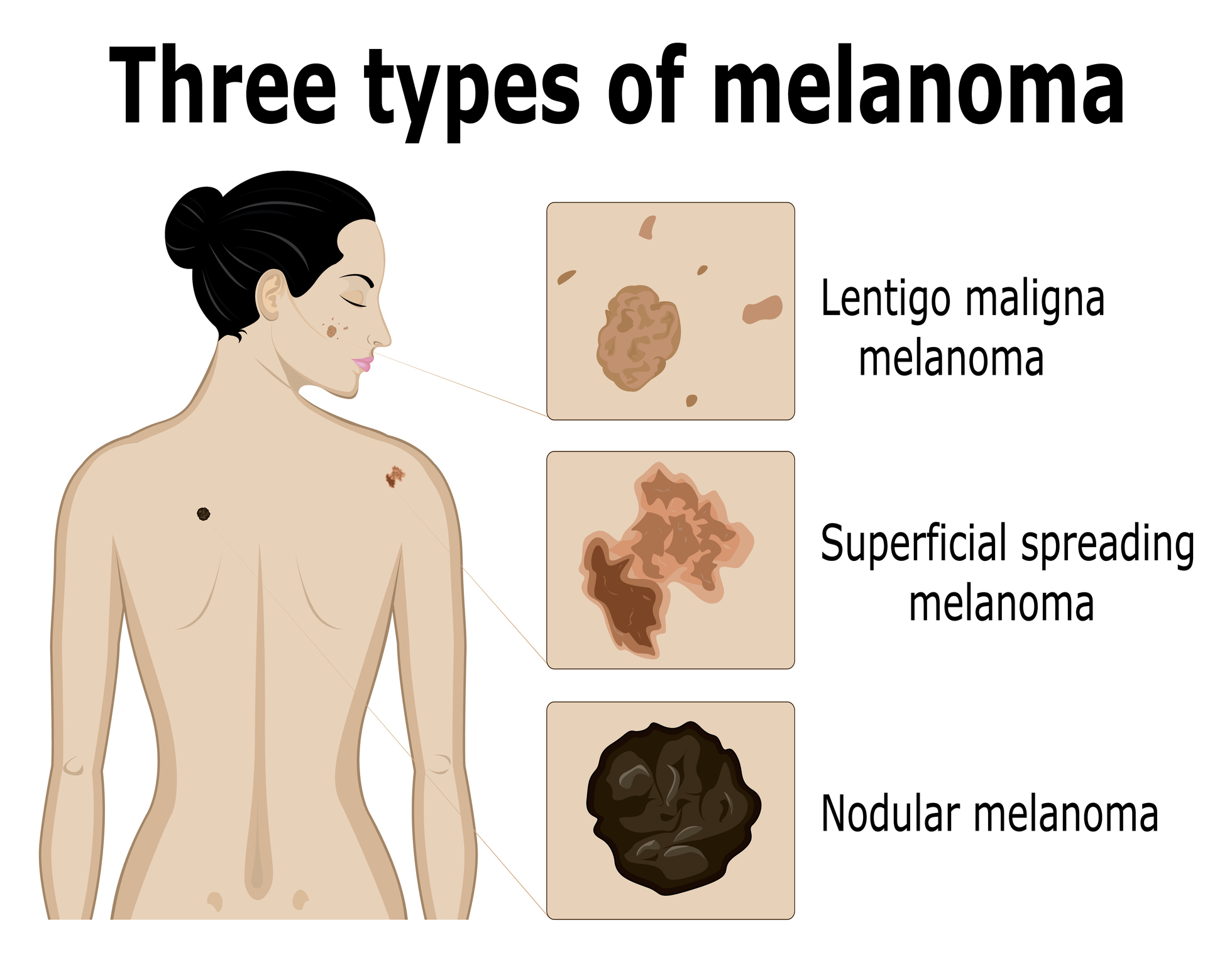 Kolme tüüpi melanoomi kuvamine