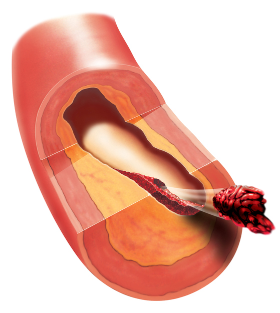 Tromboos veresoones, trombi vabanemine, emboolia, emboolia verehüübe poolt