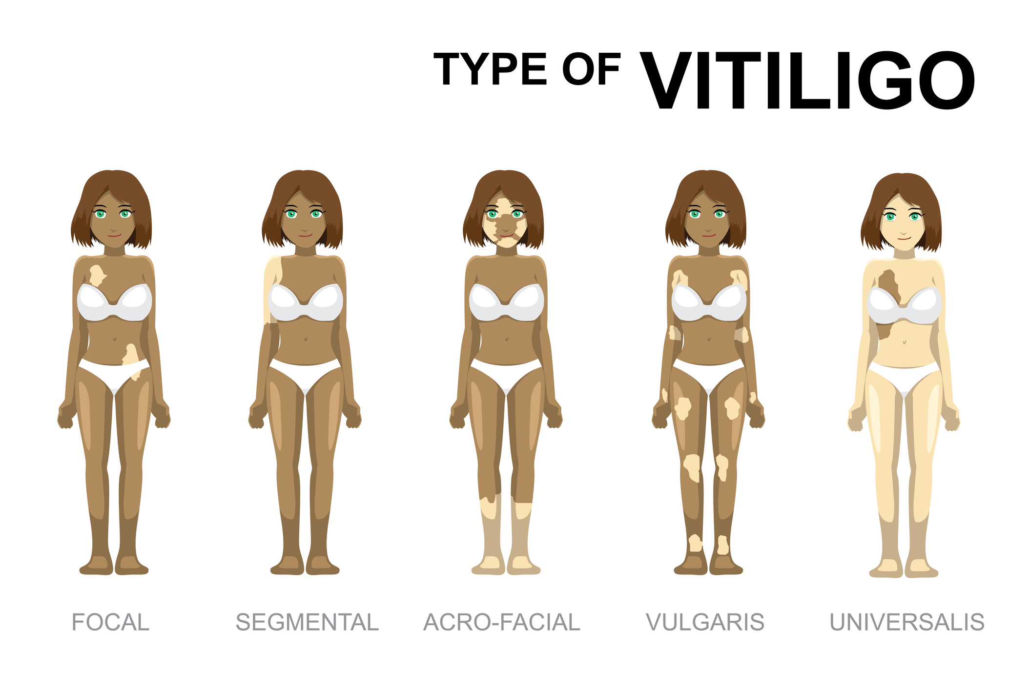 Vitiligo tüübid