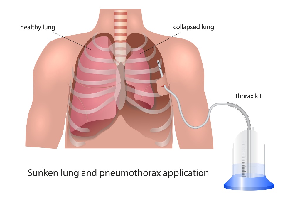 Pleura drenaaži visualiseerimine pneumotooraksi korral: terve kops, kollapsiaalne kops ja drenaažiseade