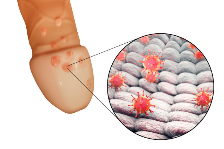 genitaalherpes peenisel ja herpesviirus mikroskoopilisel tasandil