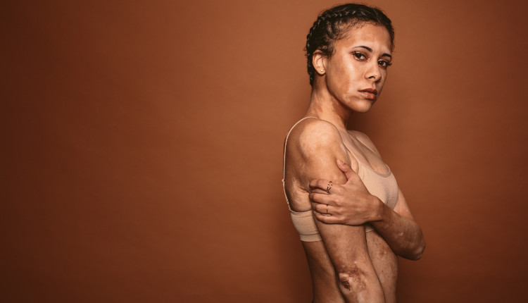 naine, kelle kehal on valged laigud - vitiligo