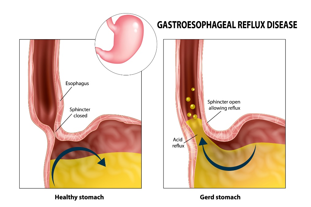 Gastroösofageaalne refluks: söögitoru, sfinkter, mao ja maohape