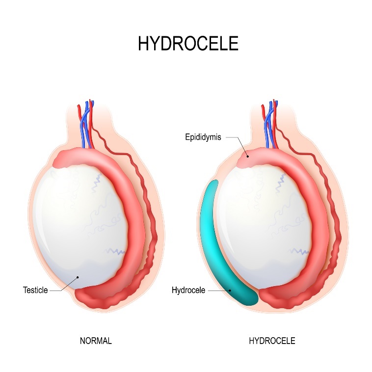 Hüdrotsele: munand, epididymis, hüdrotsele (akumuleerunud vedelik).