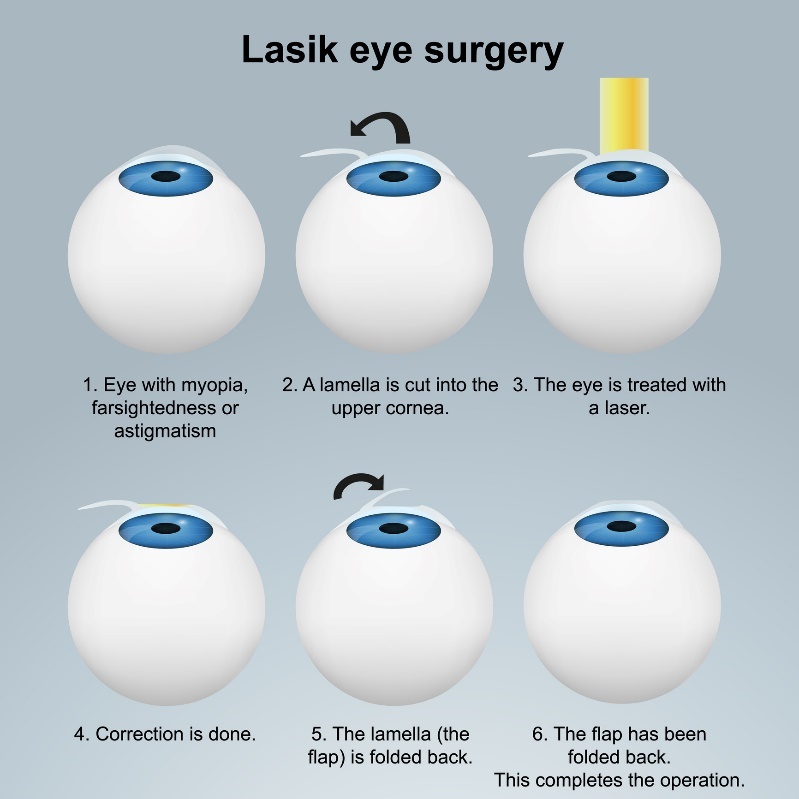 Silmade laseroperatsioon LASIK - allapinnaline meetod. Protseduur lapp/lapiga ilma närvilõpmeid kahjustamata.