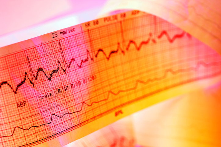 EKG salvestamine