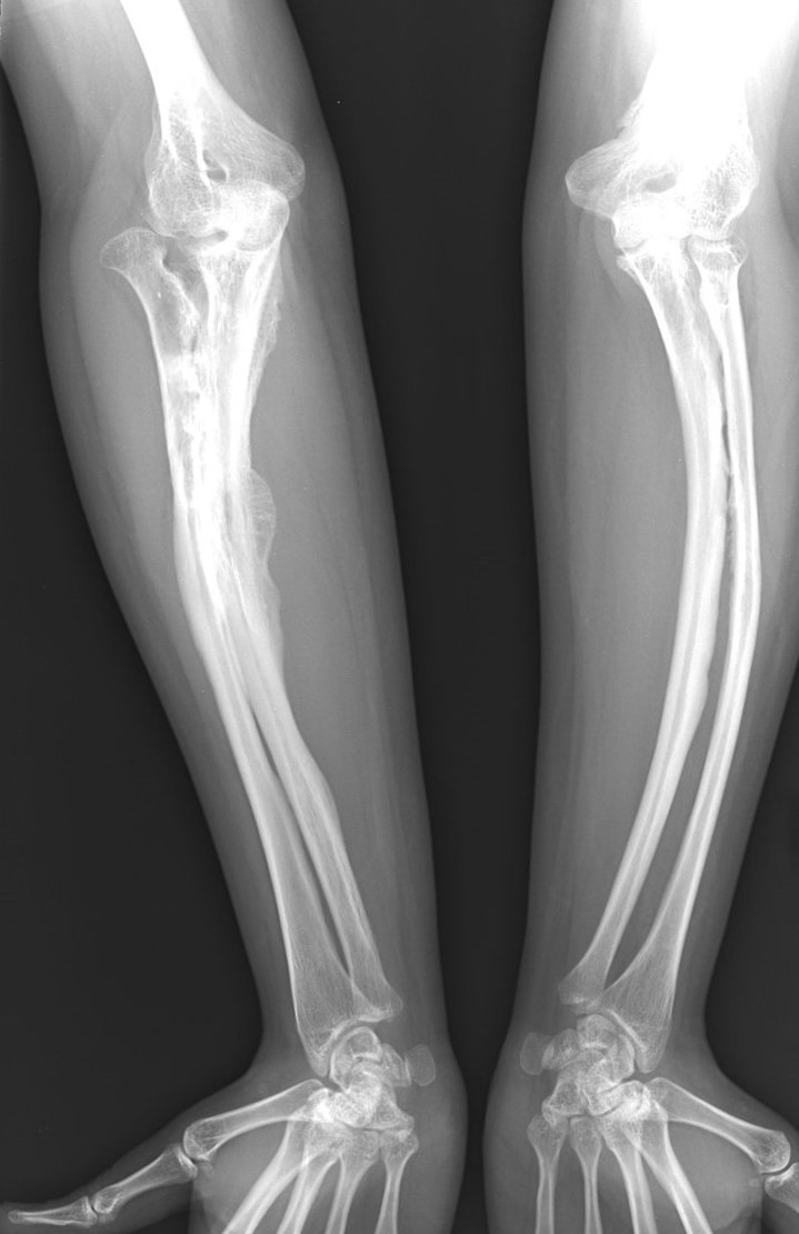 Osteogenesis imperfecta haiguse röntgenülesvõte täiskasvanud inimesel