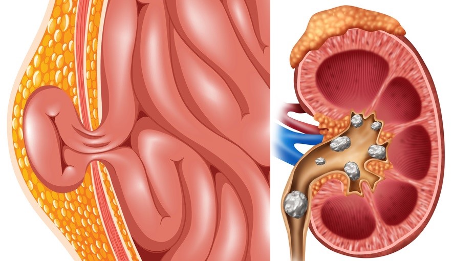 Hernia, neeru- ja uriinikivid