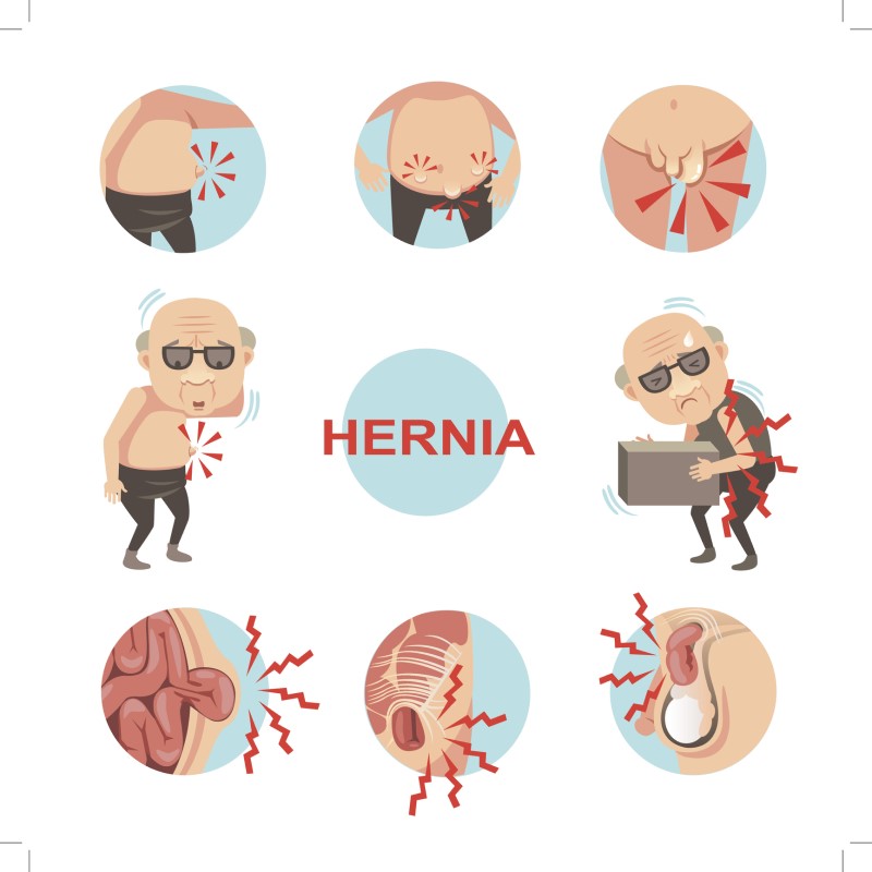 Infograafik hernia jaoks