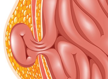 Hernia, mis on kõige sagedasem tüsistus astsiidi puhul.