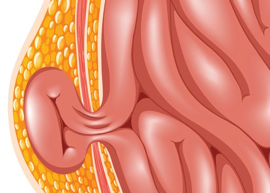 Hernia mudel, st kõhuseina hernia.