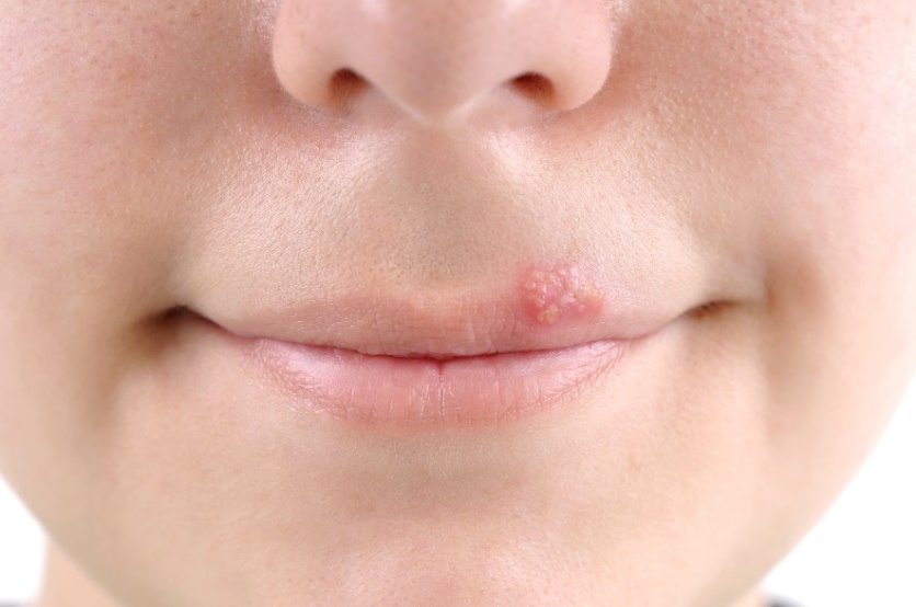 Villid - külmavillid (herpes) suu limaskesta ümber.