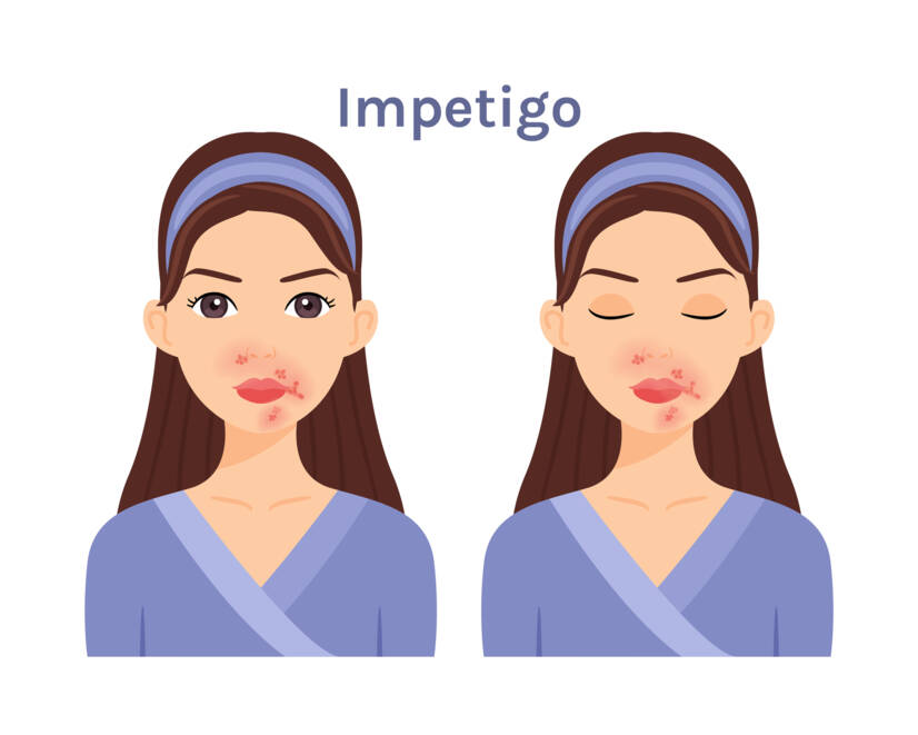 Mis on impetiigo, millised on selle sümptomid? Nakkavus ja edasikandumine lastel