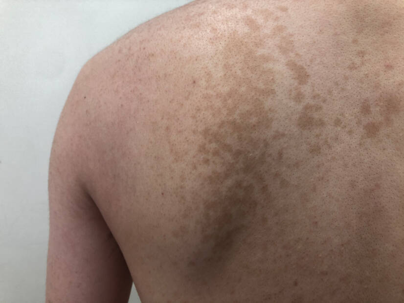 Pityriasis versicolor: Mis on see ja millised sümptomid on? Põhjused ja levik