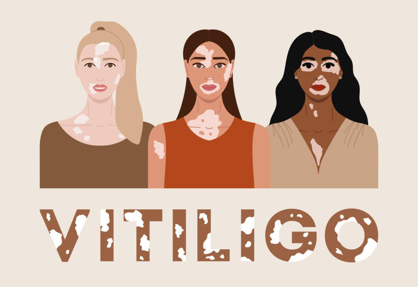 Vitiligo: Mis on vitiligo ja millised on selle põhjused ja sümptomid? Millal see algab?