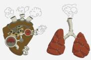 Pulmonaalne hüpertensioon: mis see on ja miks see tekib? + Sümptomid ja ravi